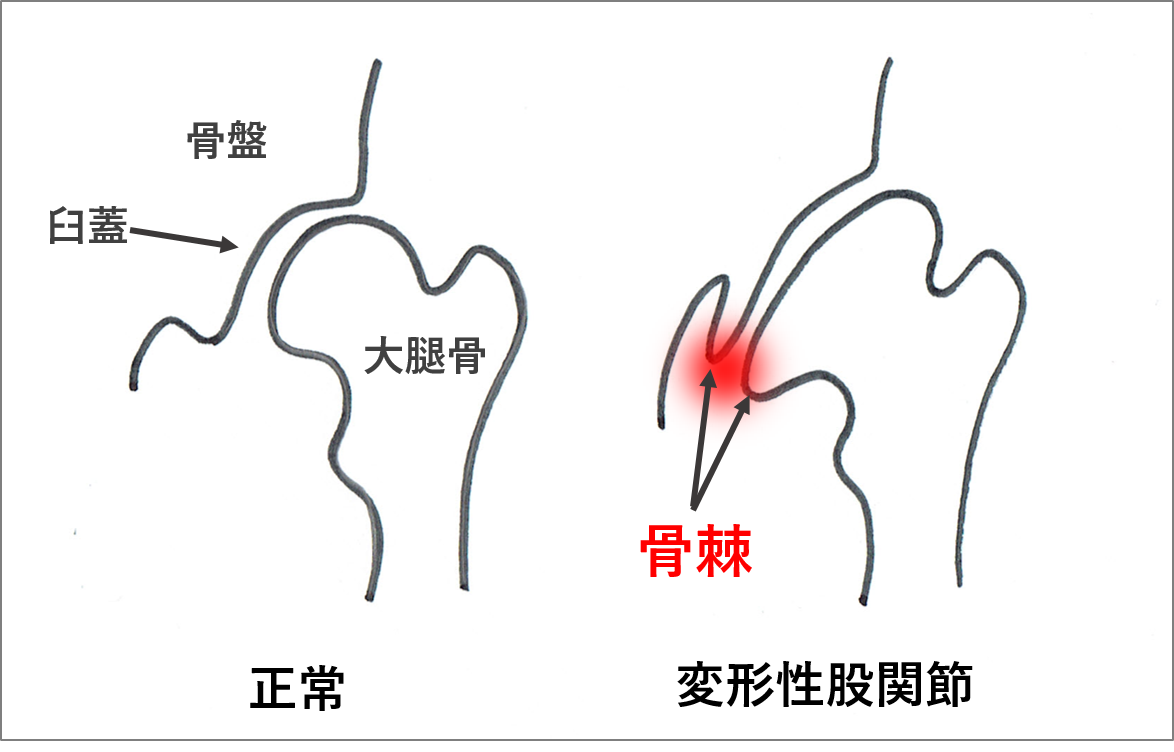 ４０代女性に多い 股関節の痛み の治し方 京都 北区 上京区 肩こり 腰痛 整体 外反母趾 野球肩 整体ならもり鍼灸整骨院