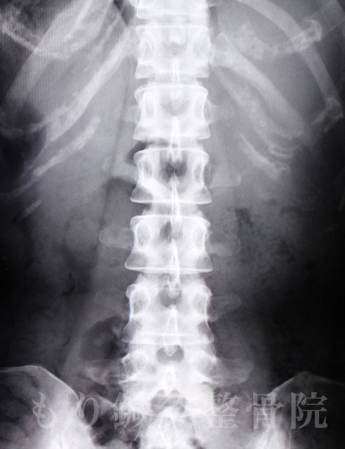 脊柱管狭窄症の治療