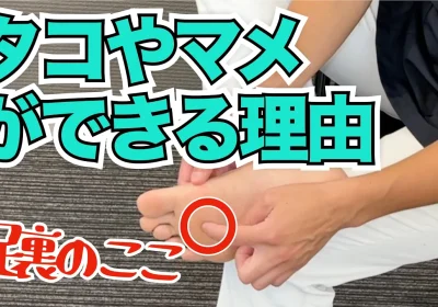 足裏にタコやマメができる原因とは？改善のための2つのポイント