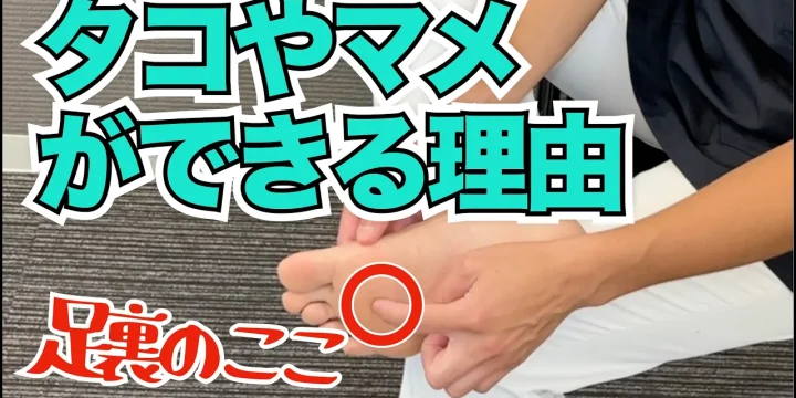 足裏にタコやマメができる原因とは？改善のための2つのポイント