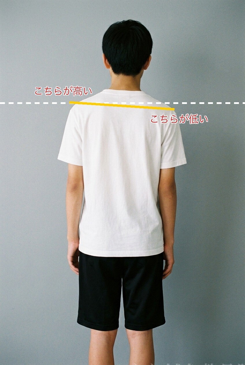 左右の肩の高さに差がある背中の例(AIで作成したイメージ図)