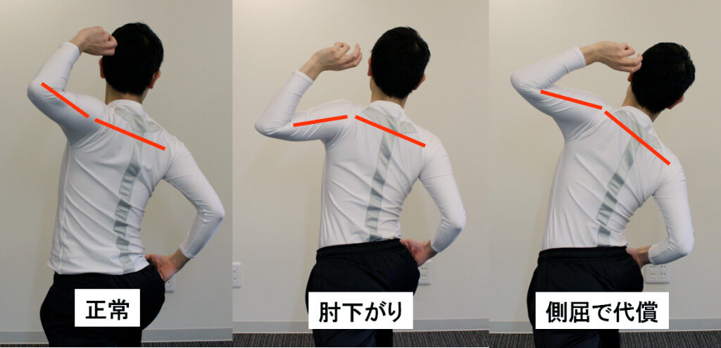 正常な投球フォーム、肘が下がったフォーム、側屈で代償したフォームを背面から並べて比較した写真
